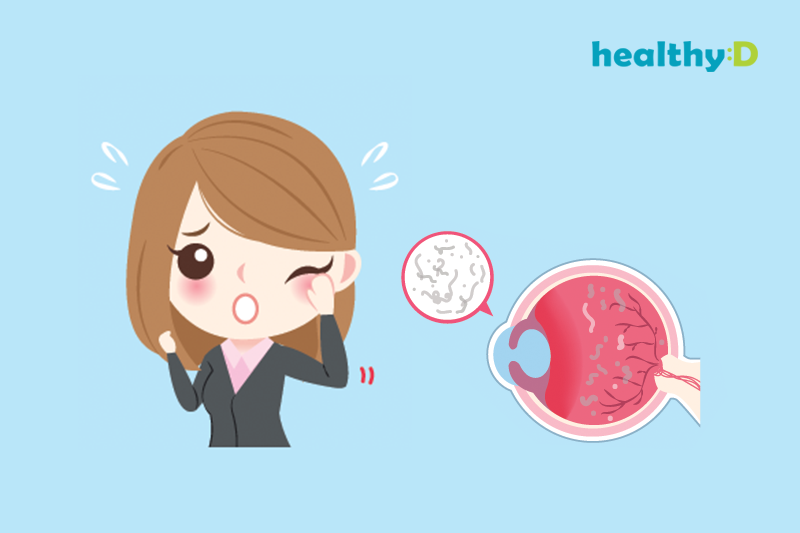 「飛蚊」頻出現？或屬視網膜脫落先兆