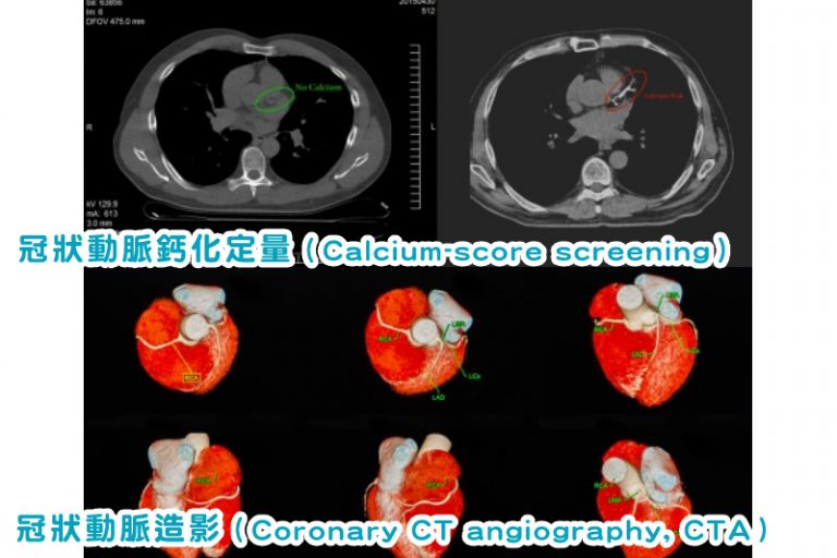 冠狀動脈鈣化定量 vs 冠狀動脈造影