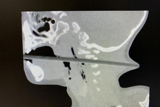【家居意外】2歲童邊玩邊拿筷子插蘋果吃 不慎跌倒致筷子貫穿喉嚨