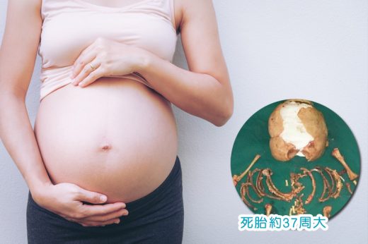 宮外孕｜60歲婦嚴重腹痛2個月求診 醫生取出36年前死胎完整骨頭