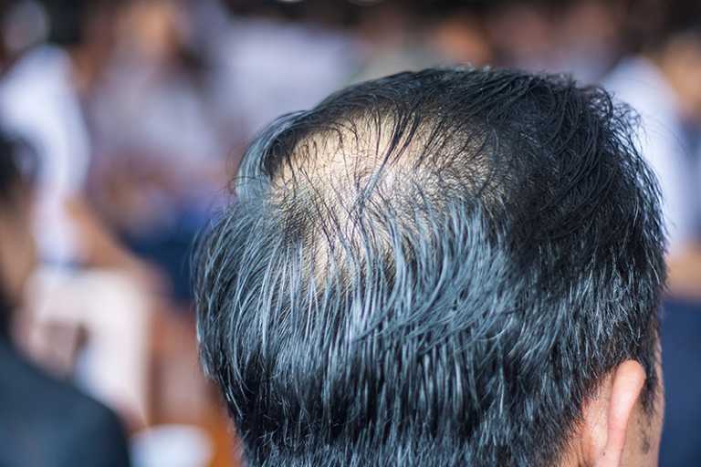 hair-loss