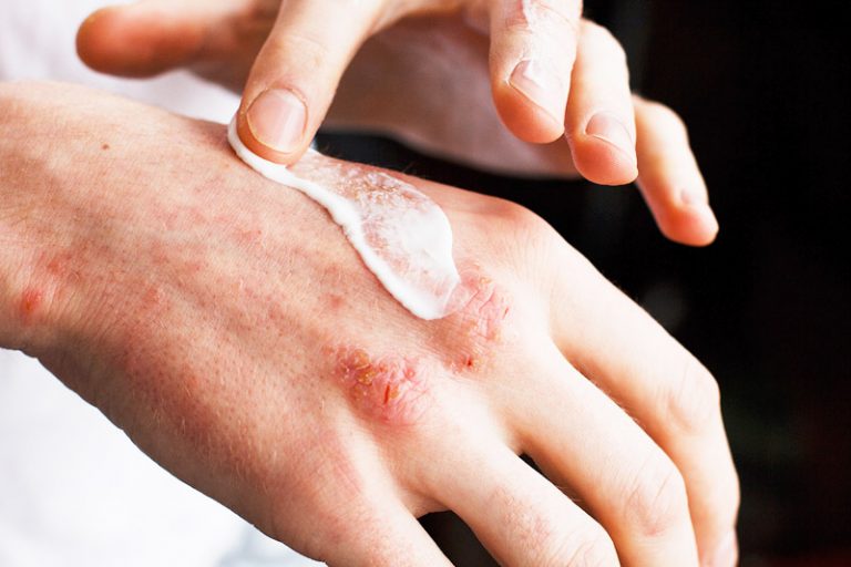 濕疹手