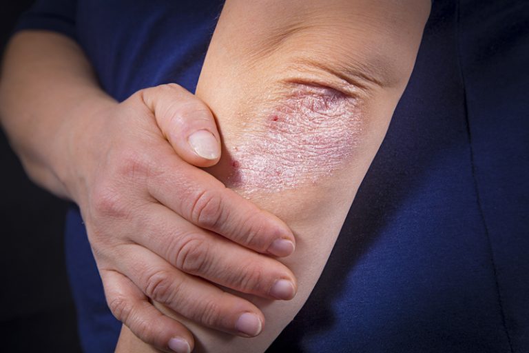 銀屑病-飲食-濕疹-前兆-病徵-牛皮癬