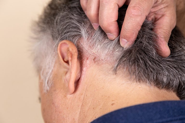 銀屑病-頭皮-飲食-濕疹-前兆-病徵-牛皮癬