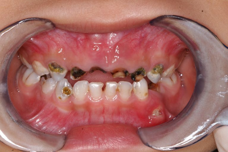 兒童口腔嚴重蛀牙