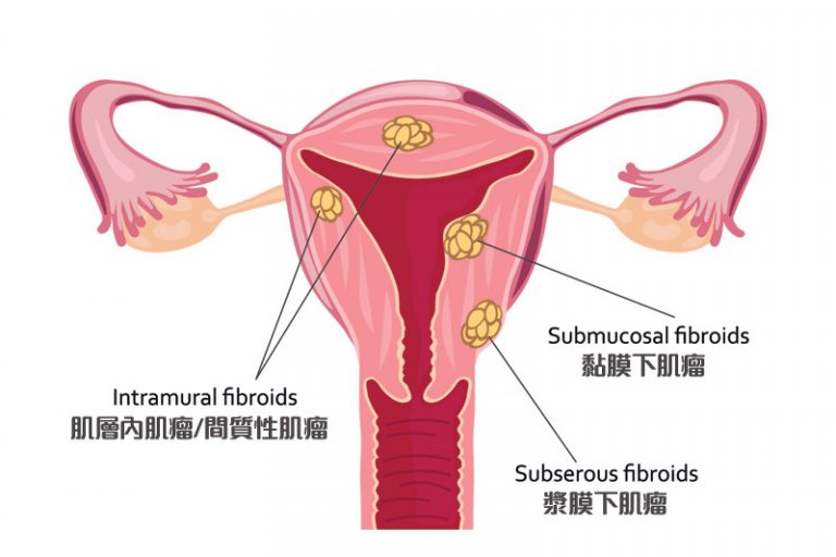 子宮肌瘤-病徵