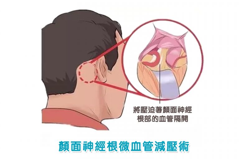 眼眉跳-面部抽搐-腦神經外科醫生-半邊面肌痙攣症1