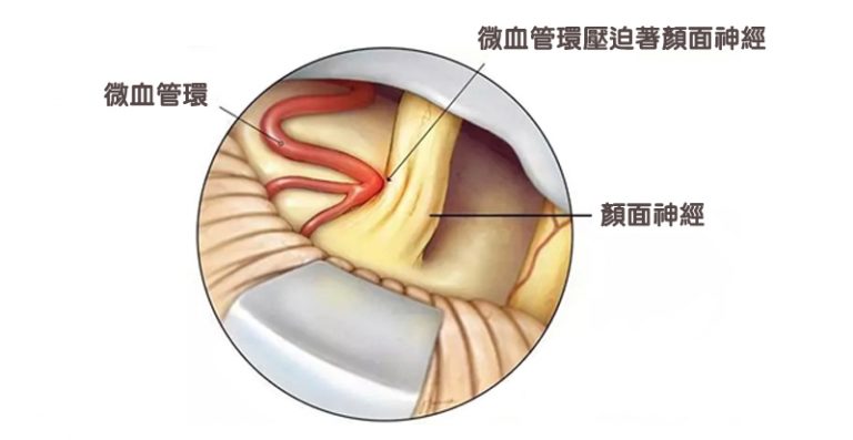 眼眉跳-面部抽搐-腦神經外科醫生-半邊面肌痙攣症2