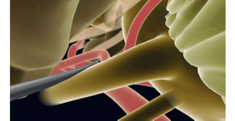 眼眉跳-面部抽搐-腦神經外科醫生-半邊面肌痙攣症3