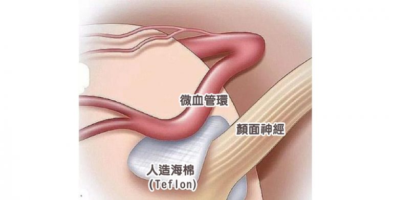 眼眉跳-面部抽搐-腦神經外科醫生-半邊面肌痙攣症4
