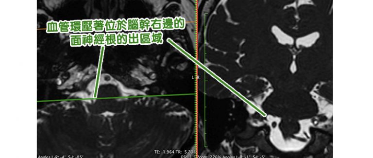 眼眉跳-面部抽搐-腦神經外科醫生-半邊面肌痙攣症5