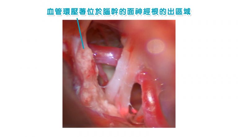 眼眉跳-面部抽搐-腦神經外科醫生-半邊面肌痙攣症6