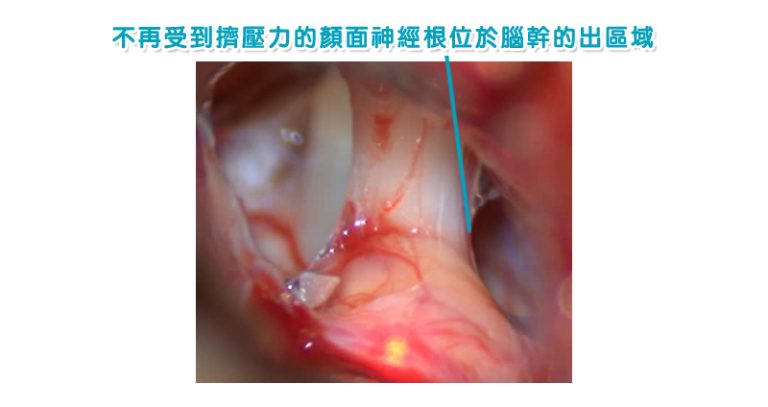 眼眉跳-面部抽搐-腦神經外科醫生-半邊面肌痙攣症8
