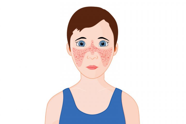 紅斑狼瘡病徵-成因-併發症-預防-3