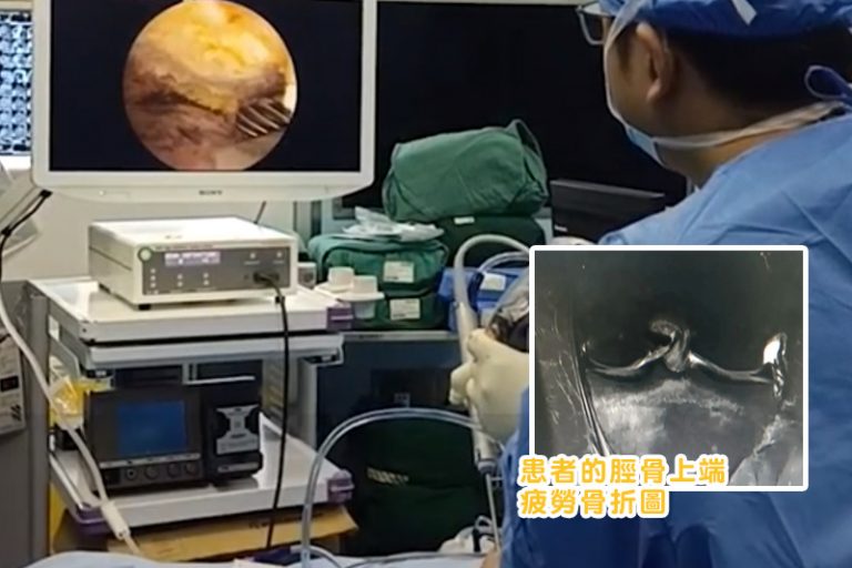 患者脛骨上端疲勞骨折圖