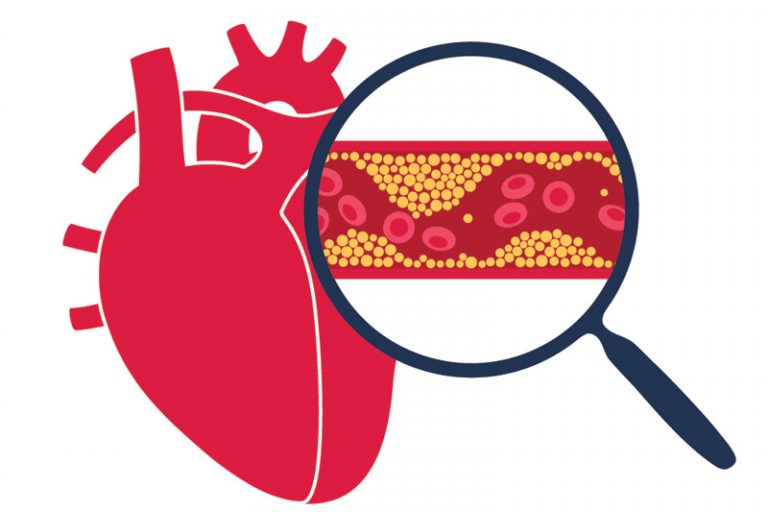 新冠疫苗-冠心病-血管收窄-定期檢查心臟年齡