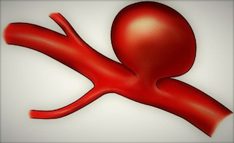 腦血管動脈瘤-中風-頭痛2