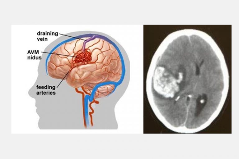 中風-先天性大腦動靜脈畸形血管瘤爆破而引致的嚴重出血性中風