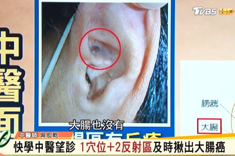 中醫可根據耳朵及面部的「反射區域」表現來揪出大腸癌