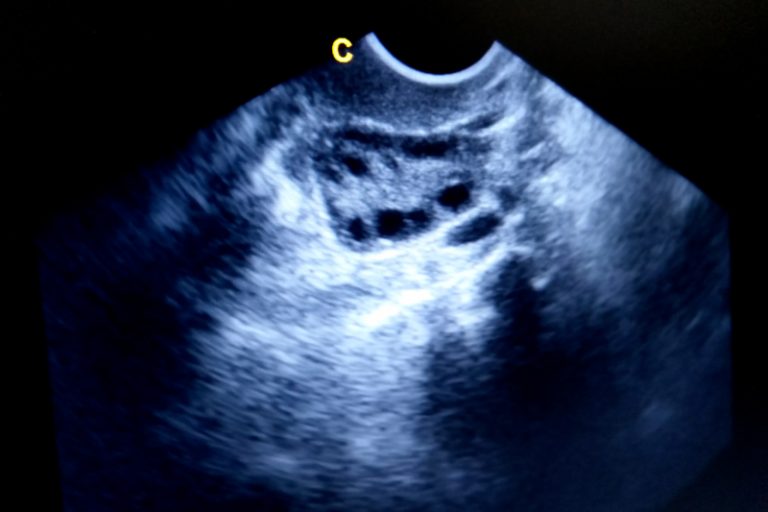 多囊卵巢症-不孕-經期不準2