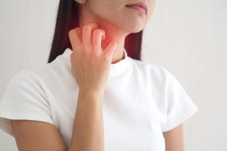 風癩-蕁麻疹-症狀及中醫治療