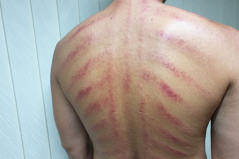 中醫拆解刮痧功效原理