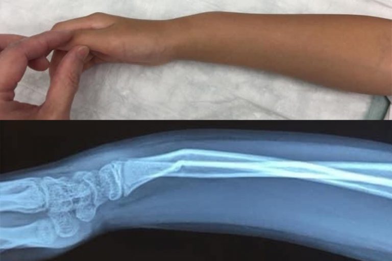 兒童前臂骨折-康復時間