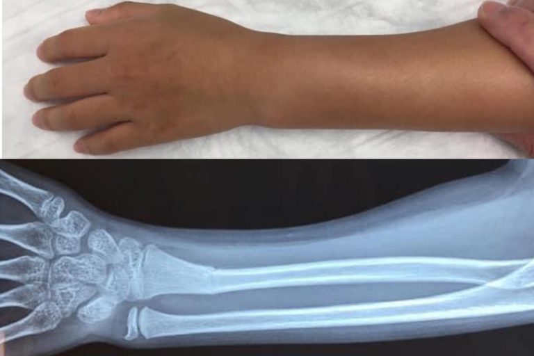 兒童前臂骨折-康復時間