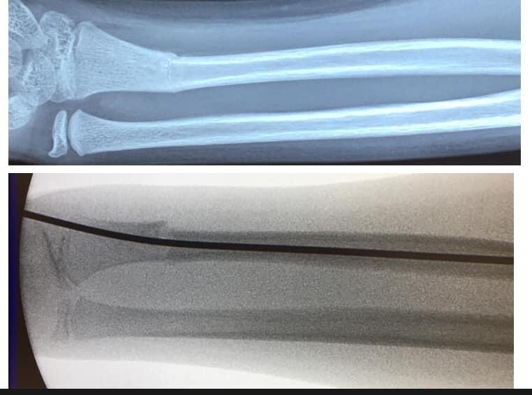兒童前臂骨折-康復時間-X光判斷4