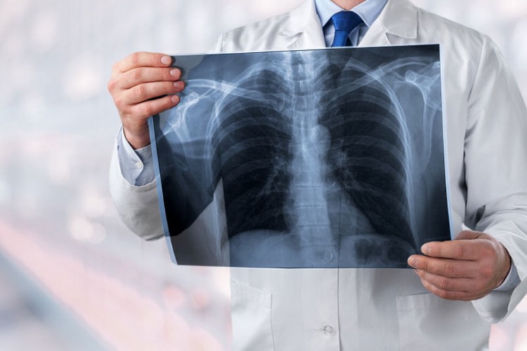 肺癌-檢測-治療