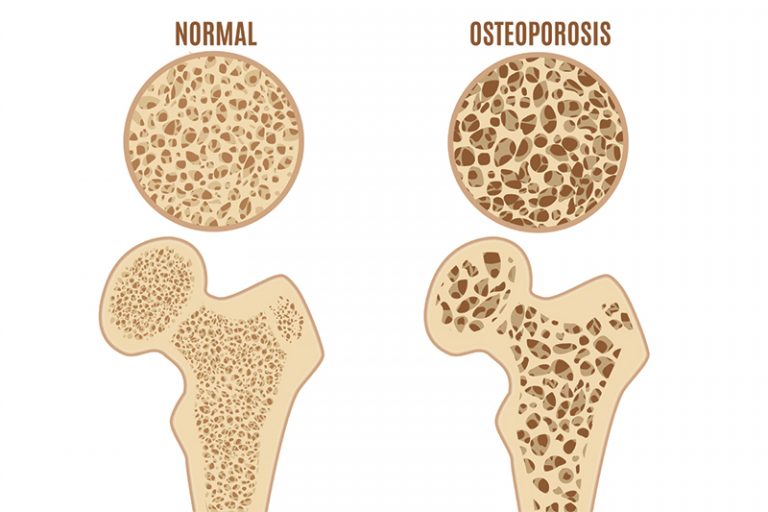 骨質疏鬆檢查-症狀