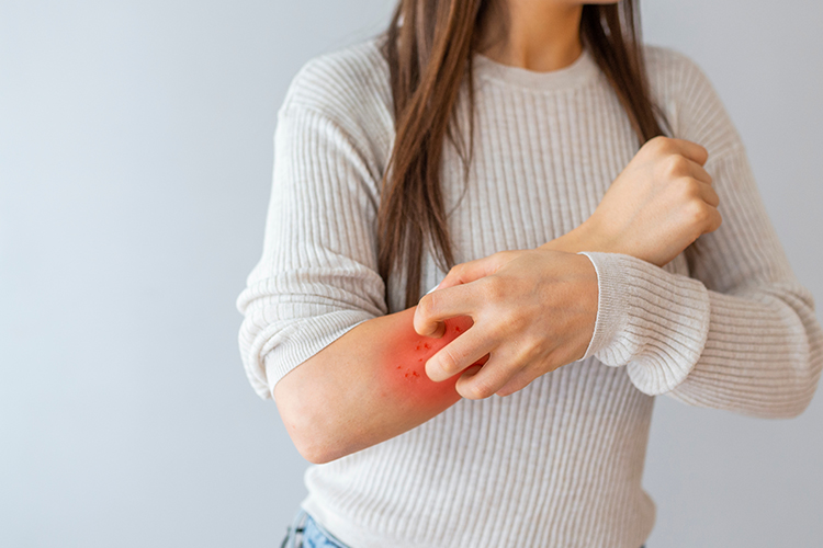 銀屑病生物製劑 /牛皮癬生物製劑