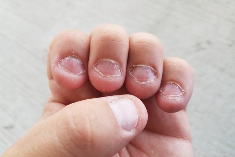 咬指甲-強迫症-焦慮症