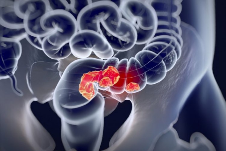 大腸癌-胃癌-大腸鏡檢查-胃鏡