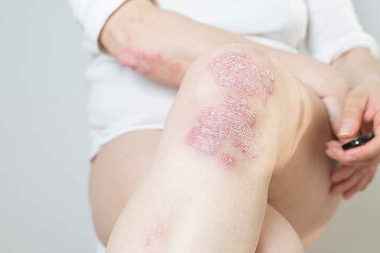 牛皮癬-治療-生物製劑-皮膚科