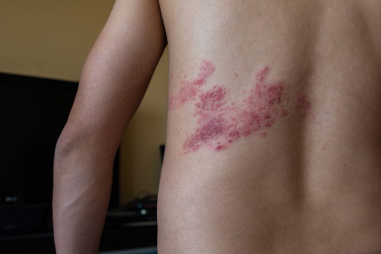 生蛇位置-背部-中醫-西醫治療