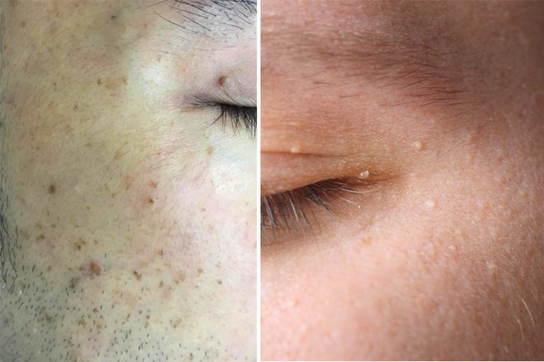 扁平疣-疣自己消失-病毒疣-成因-治療-皮膚科醫生-胡惠福