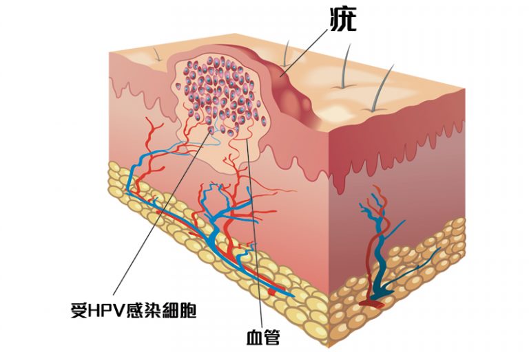 疣自己消失-病毒疣-手指-尋常疣-扁平疣-腳底疣-性病疣-成因-治療-醫生