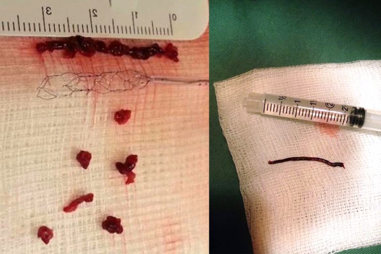 缺血性中風-急救-手術治療-個案-腦血管外科