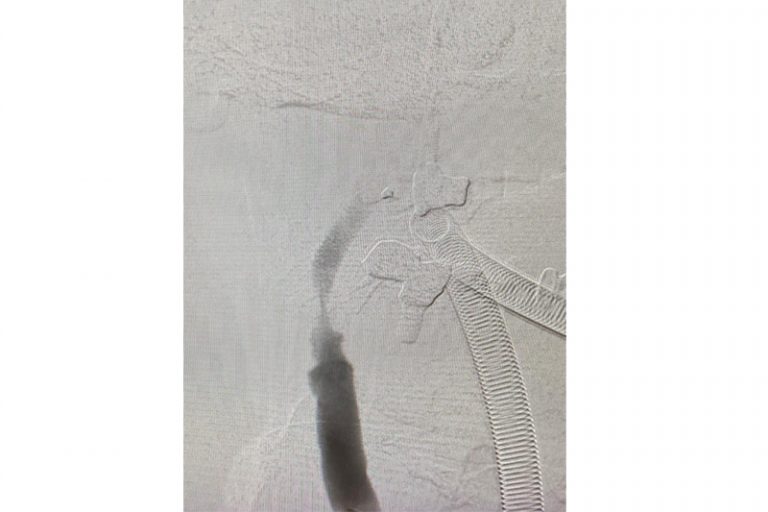 缺血性中風-急救-手術治療-個案-腦血管外科