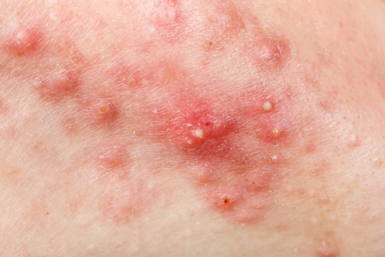 暗瘡-玫瑰痤瘡分別-成因-症狀-治療-皮膚專科-胡惠福醫生