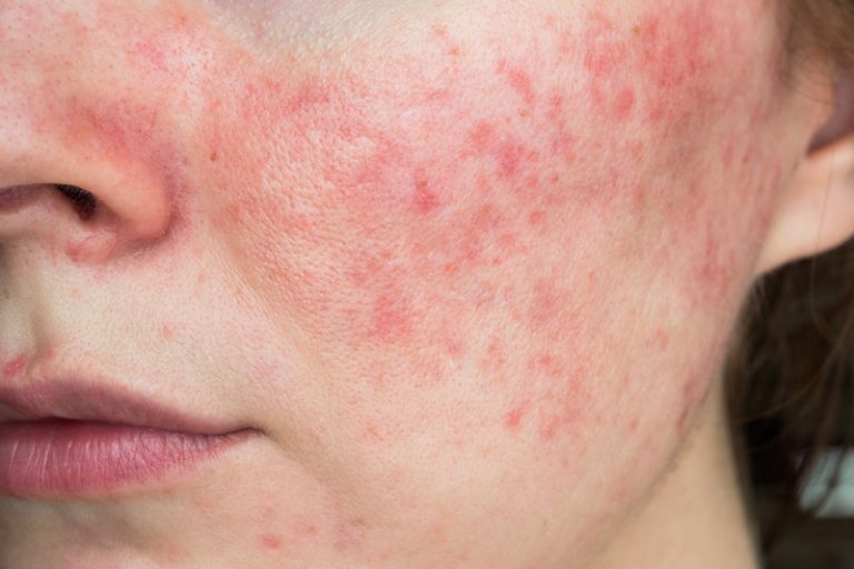 玫瑰痤瘡-面部丘疹-暗瘡-成因-症狀-治療-皮膚專科-胡惠福醫生