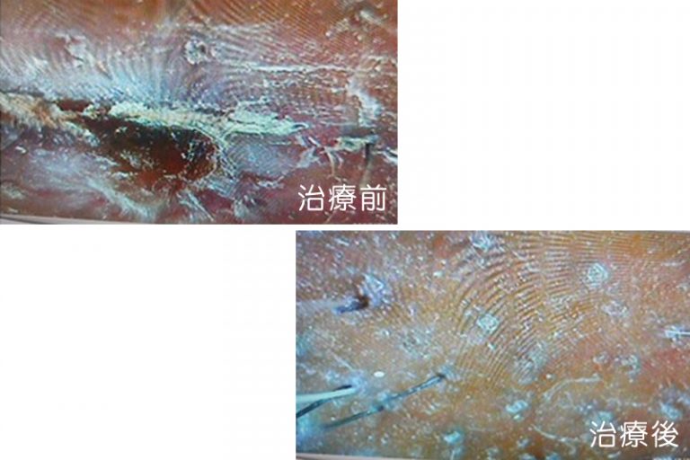 生頭瘡-油膩麻辣食物-中醫拆解頭皮生瘡常見原因-治療方法