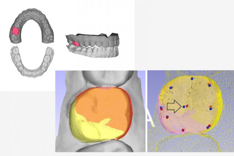 港大牙醫學院-人工智能自動化設計假牙
