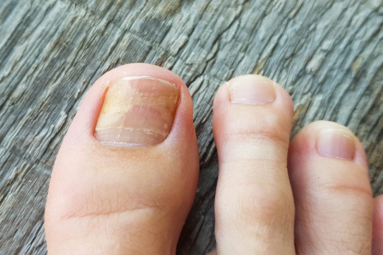 行山健康攻略-行山鞋-灰甲-雞眼-瑜珈褲-尿道炎-袁靜怡醫生