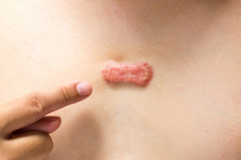 蟹足腫｜調查：7成港人對蟹足腫缺乏認知｜醫生拆解蟹足腫原因和治療方法_圖_2