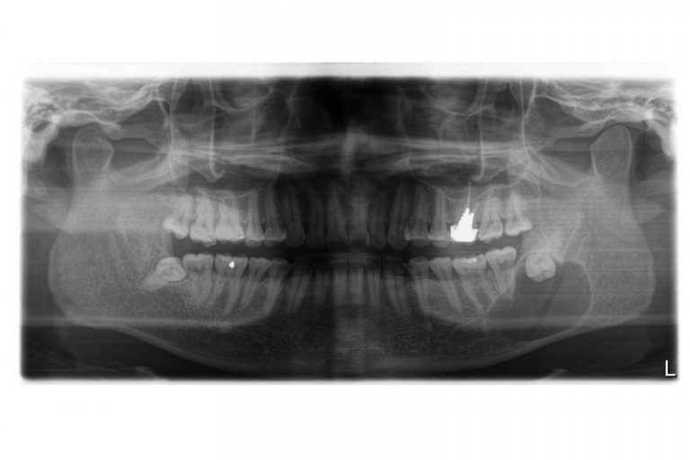 智慧齒阻生令顎骨內其他組織病變而形成顎骨囊腫