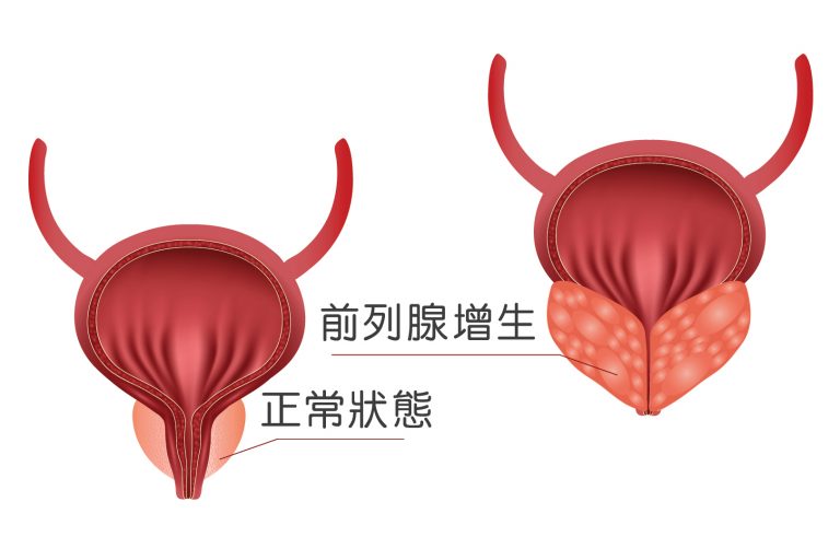 泌尿疾病-前列腺肥大-症狀-原因-診斷-治療-手術