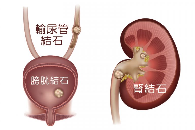 泌尿疾病-腎結石-尿路結石-症狀-原因-診斷-治療-手術
