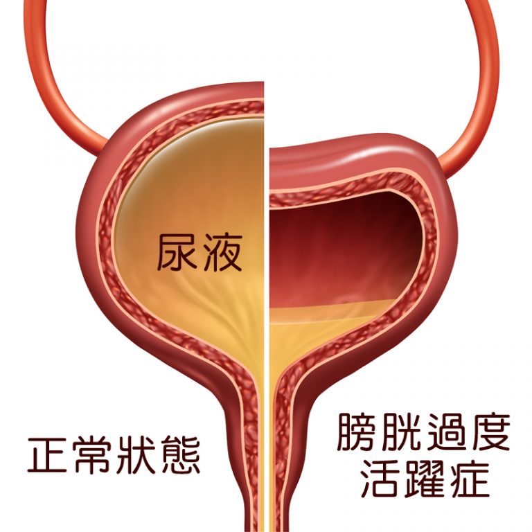 泌尿疾病-膀胱過度活躍症-腎結石-症狀-原因-診斷-治療-手術